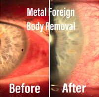 Metal Foreign Body Removal