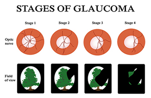 Stages of Glaucoma
